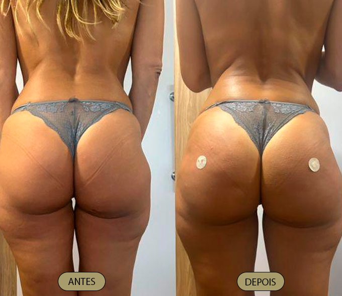 harmonizacao-gluteo-dra-carla-aguiar-2