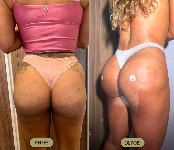 harmonizacao-gluteo-dra-carla-aguiar-3