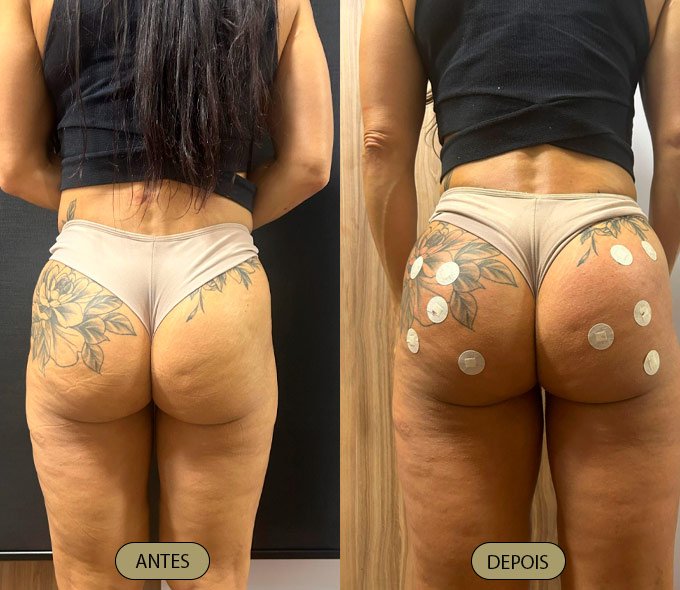 harmonizacao-gluteo-dra-carla-aguiar
