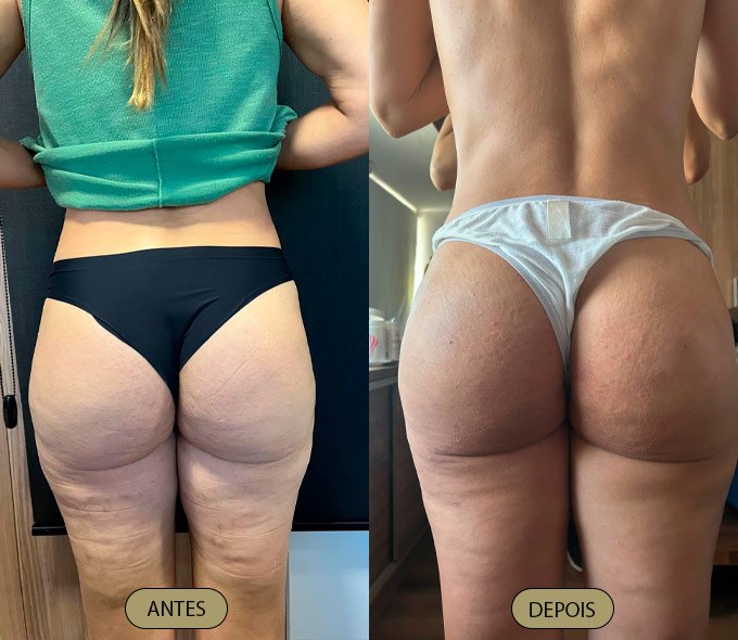 Tratamento Lipedema - Dra. Carla Aguiar
