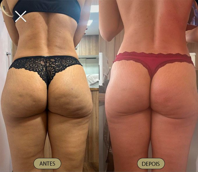 Tratamento Lipedema - Dra. Carla Aguiar