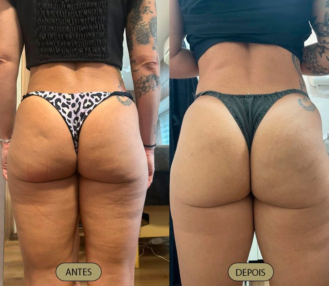 Tratamento Lipedema - Dra. Carla Aguiar